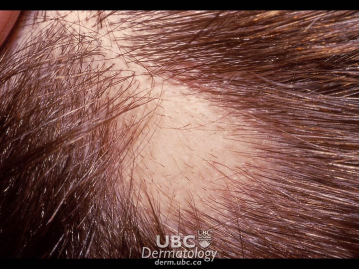 hair disorders-1 alopecia areata