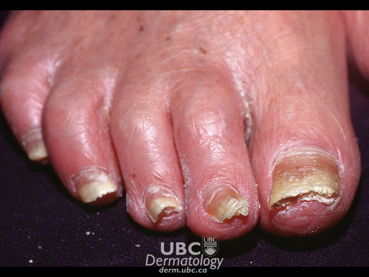 nail disorder-1 psoriasis