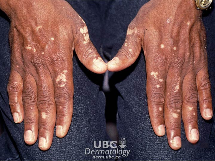 vitiligo-1